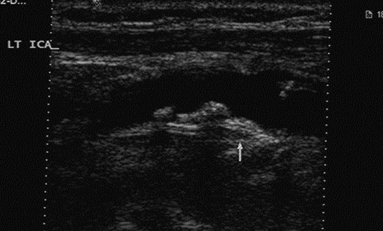 Lipid Changes Around the Final Menstrual Period Predict Carotid Subclinical Disease in Postmenopausal Women